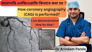 করোনারি এনজিওগ্রাফি কিভাবে করা হয় Live demonstration how Coronary Angiography  CAG is done Dr AP [upl. by Eelaras]