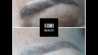 Tattoo removal laser and scar free for eyebrow microblading [upl. by Karol]