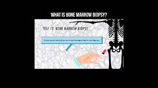 What is bone marrow biopsy biopsy bonemarrow [upl. by Anail979]