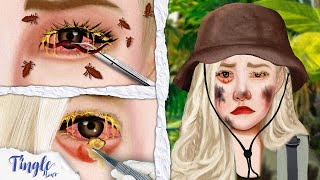 ASMR Oddly Satisfying Removal Bloodsucking Leech Eye amp Lashes Deep Cleaning  Eyelash Lice Treatment [upl. by Ettenowtna]