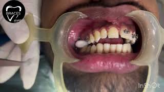 CLASS 2 DIV 1  BRACES  ORTHODONTICS  ANANTNAG trending braces dentist imrankhan [upl. by Ednarb936]