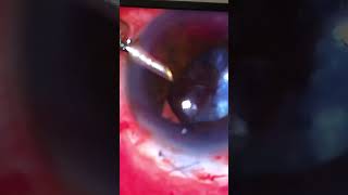 Vitrectomy with corticotomy [upl. by Cyrillus]