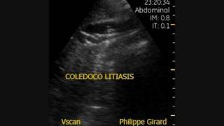 Vscan Coledocolitiasis con barro biliar [upl. by Bilbe241]