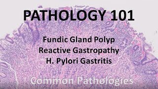 Fundic Gland Polyp Reactive Gastropathy and H Pylori gastritis  Pathology 101 GI Pathology [upl. by Saul4]