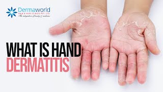 What is Hand dermatitis Shots [upl. by Schiff]