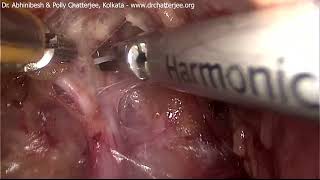 TLH for anterior cervical fibroid after uterine artery ligation  origin amp ureteric dissection [upl. by Aver]