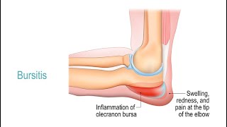 Treating Bursitis [upl. by Nireil]