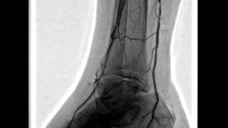 Balloon angioplasty of the popliteal artery [upl. by Eanod]