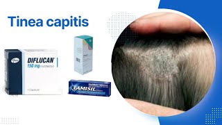 tinea capitis تنيا الرأس [upl. by Hurst]