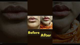 You MUST Watch  💋Lip Filler Injection for Fuller Plump Lips [upl. by Thornie]