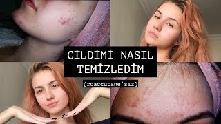 SİVİLCELERİMDEN NASIL KURTULDUM ✨ roaccutane’sız [upl. by Loree895]