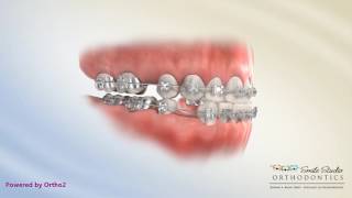 Upper 5 Lower 4 Extraction  Underbite  Orthodontic Treatment [upl. by Hsekar]