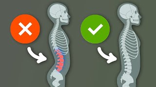 Lordosis Do THIS for a straighter posture Hyperlordosis ✔ [upl. by Belsky]