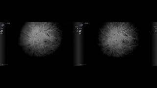 Intraoperative fluorescein angiography during vitrectomy  NGENUITY 3D [upl. by Hike]