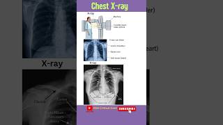 Chest Xray  Xray Machine  Chest Xray Findings  Xray of Chest  PA viewcxr chestxray Xray [upl. by Adihsaar]