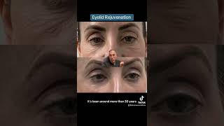 Eyelid Rejuvenation [upl. by Altman]