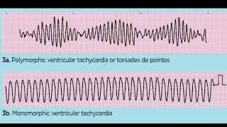 TORSADES DE POINTES 4TH YR [upl. by Shay749]