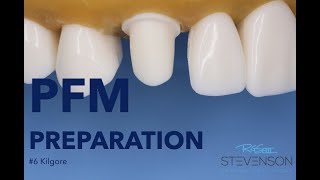 PFM Preparation on The Canine Tooth 6 Kilgore  Stevenson Dental Solutions [upl. by Almeeta]