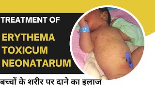 Erythema toxicum neonatarum skin rashes in newborn baby cause and treatmentDr Uttam kumar Lenka [upl. by Brynna]