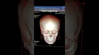 Parietal and occipital bone fracture [upl. by Clemmie660]