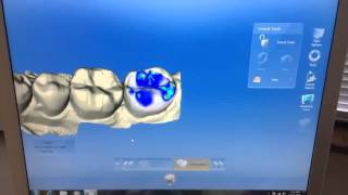 CEREC Crowns A OneVisit Procedure  Dr Brian Mills [upl. by Orsay]