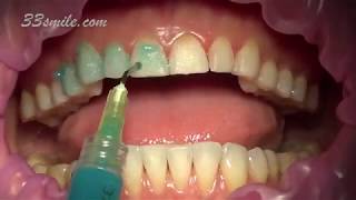 Prepless Veneers Permanent Teeth Whitening [upl. by Atnuahsal]