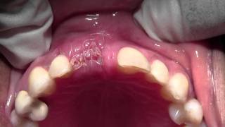 Implant Placement with Bone Grafting 8 Site Mineross amp dPTFE 1 Week postop [upl. by Aruabea]