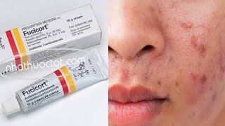 Best Acne solution 100 [upl. by Tanya793]