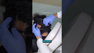 Discoid Lupus  How it Causes Permanent Hair Loss alopecia hairlossdoctor htx lupus houston [upl. by Norre]