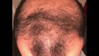 6 months using minoxidil  Rogaine 5 Before amp After results [upl. by Eleik]