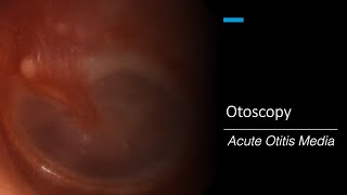 Acute Otitis Media Otoscopy [upl. by Ylenaj846]