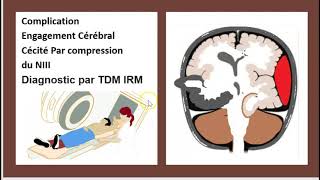 Comment diagnostiquer une HTIC  Syndrome dHypertension Intracrânienne Hernie cérébrale 3 Minutes [upl. by Leonelle839]