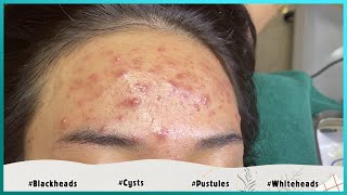 Big Cystic Acne Blackheads Extraction Blackheads amp Milia Whiteheads Removal Pimple Popping [upl. by Airekahs]