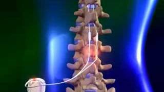 Spinal cord stimulator [upl. by Wirth]