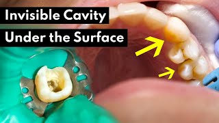 How Dentists Treat INVISIBLE CAVITIES [upl. by Atsed]