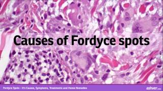 Fordyce Spots  Its Causes Symptoms Treatments and Home Remedies [upl. by Marijane785]