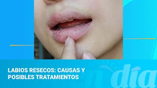 Labios resecos causas y posibles tratamientos [upl. by Norihs]