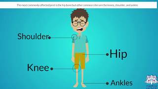 OSTEONECROSIS Causes Signs and Symptoms Diagnosis and Treatment [upl. by Cadman87]