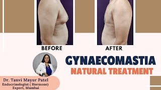 Gynaecomastia Natural Treatment  Gynecomastia Treatment Without Surgery  Dr Tanvi Mayur Patel [upl. by Sedecrem434]