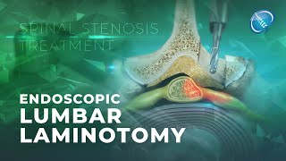 What is Endoscopic Lumbar Laminotomy  Laminectomy [upl. by Hogan]