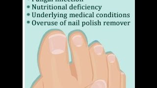 Brittle Toenail Causes [upl. by Monroy]