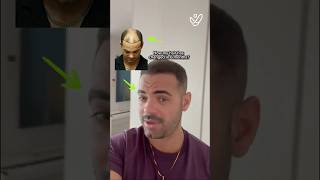 6 Month Hair Transplant Results You Wont Believe [upl. by Bernat]