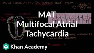 Multifocal atrial tachycardia MAT  Circulatory System and Disease  NCLEXRN  Khan Academy [upl. by Quintin]