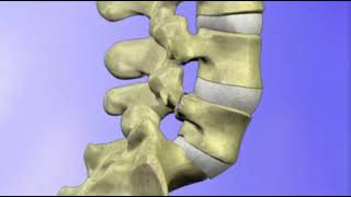 Spondylolisthesis explained [upl. by Aisor57]