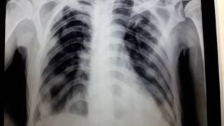 Cannonball Appearance on Xray  Pulmonary Metastasis [upl. by Takara]