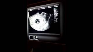 10 Weeks 5 Days Pregnant Ultrasound [upl. by Rekrap905]