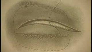 Elevation of Drooped Eyebrows [upl. by Nagam]