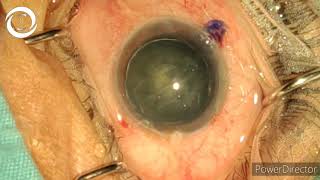 Phacoemulsification in PSC Cataract [upl. by Tyra766]