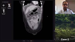 Isolation tutorial Abdominal CT 3 with Vikas Shah [upl. by Sidnala]