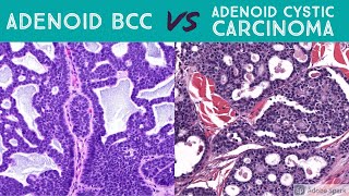 Cutaneous Adenoid Cystic Carcinoma vs Adenoid Basal Cell Carcinoma Dermpath Dermatology Pathology [upl. by Sopher]